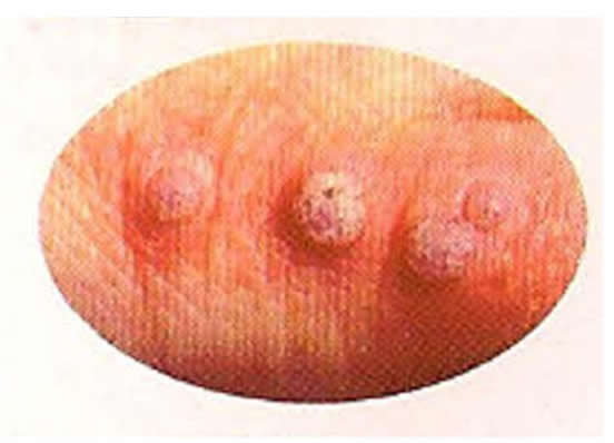 Common Warts